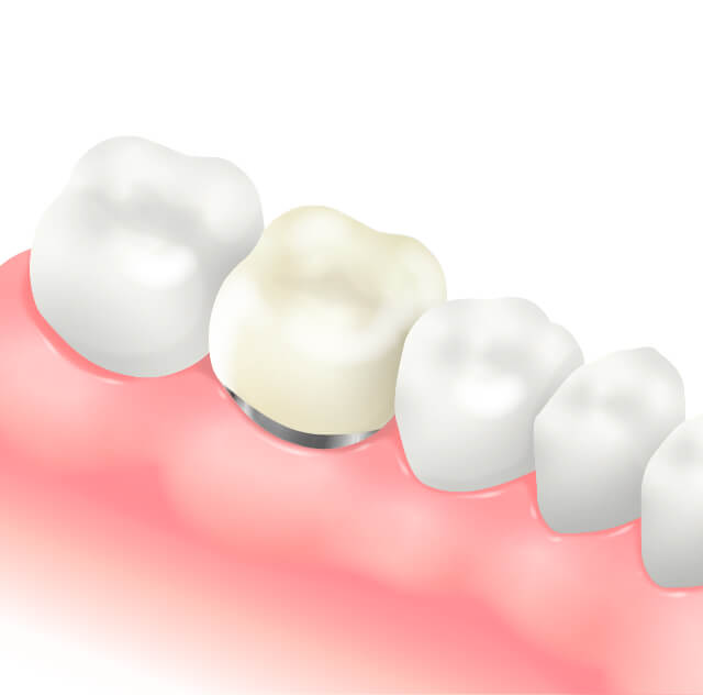 メタルボンドセラミッククラウンのイラスト