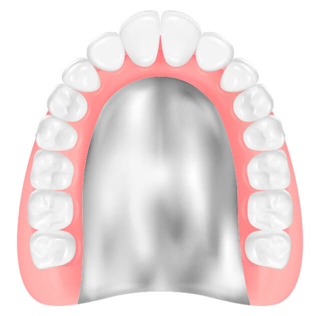 チタン床義歯のイラスト