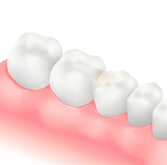 オールセラミックインレーのイラスト