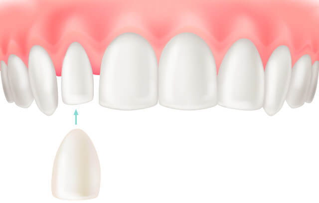 ラミネートべニアのイラスト