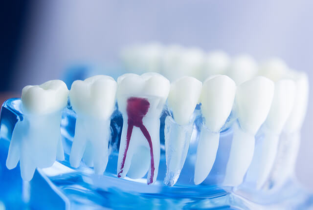 歯周病の歯の模型