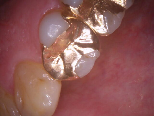 口腔内CCDカメラ（撮影事例②）