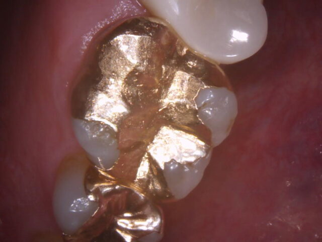 口腔内CCDカメラ（撮影事例①）